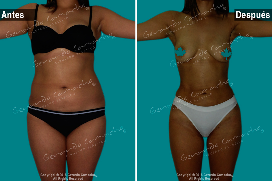 Transformación abdominal con lipólisis láser en Bogotá